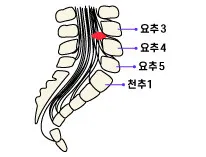 요추 3·4·5번과 천추1 디스크 부위